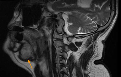 Pleomorphic Adenoma Of The Sublingual Gland Imaging Pearls And