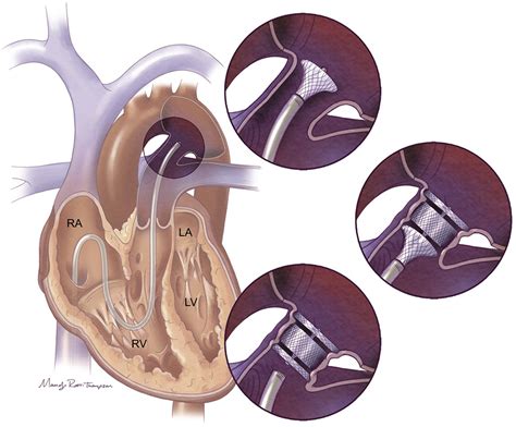 Percutaneous Closure Of The Patent Ductus Arteriosus In Very Low Weight