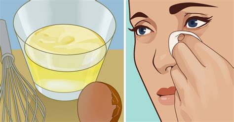 Check spelling or type a new query. Cara Menghilangkan Jerawat Mengunakan Putih Telur