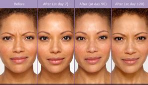 Everyone has a unique experience and results may vary. Centre médico-esthétique Botox rive-sud de Montréal