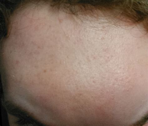 Small Colorless Bumps All Over Forehead General Acne Discussion By Nlking Community