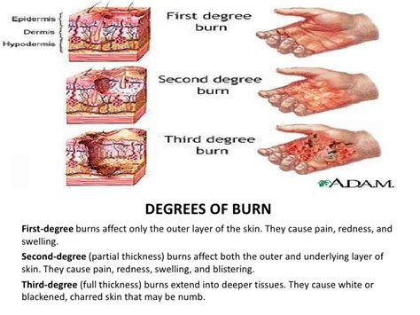Burns Injury Causes Symptoms Diagnosis Treatment