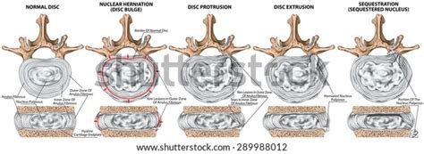 Types Stages Lumbar Disc Herniation Herniated Stock Illustration 289988012