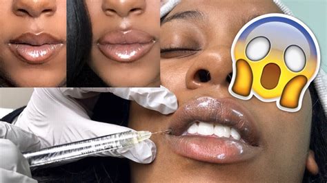 Black Girl Gets Lip Fillers Juvederm Botox Injections Vlog Youtube