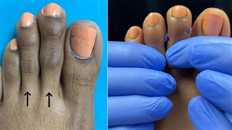 Minimally Invasive Toe Shortening Surgery Before And After Youtube