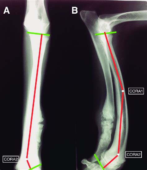 Radiographs Of The Right Antebrachium With Lines Depicting The Proximal