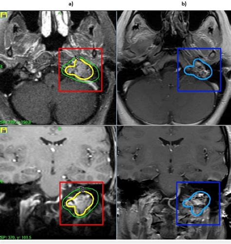 Mri Of Glomus Jugulare Tumor Before And After Gkrs A Pre Gkrs Mri Of