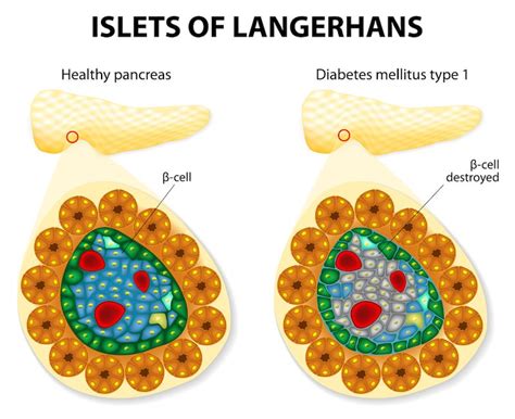 Long Sought Attack Signal In Type 1 Diabetes Identified Live Science