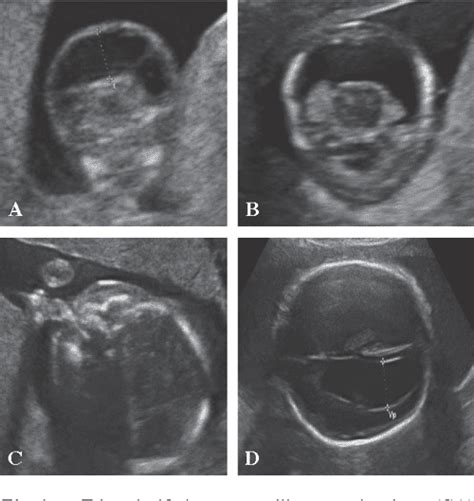 Figure 2 From Ultrasound Features In Trisomy 13 Patau Syndrome And Trisomy 18 Edwards