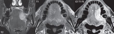 Oral Cavity Oropharynx Radiology Key