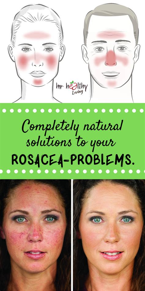 Completely Natural Solutions To Your Rosacea Problems Natural Rosacea