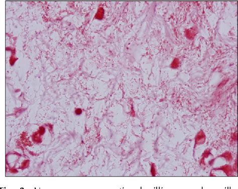 Ecthyma Gangrenosum Histology