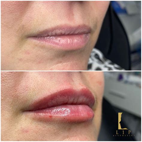 How Much Lip Filler Do I Need By Dr Ranjbar L1p