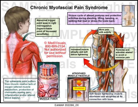 Chronic Myofascial Pain Syndrome Medical Illustration