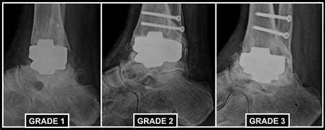 A Closer Look At Total Ankle Replacement Revision