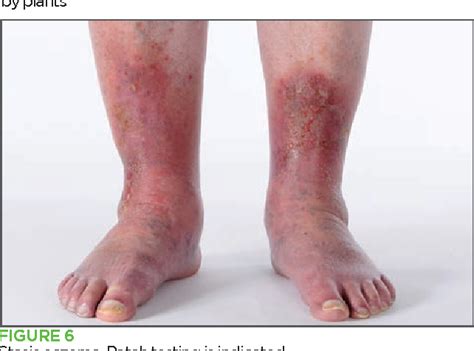 Atopic Dermatitis Leg Icd 9 Atopic Dermatitis Symptoms