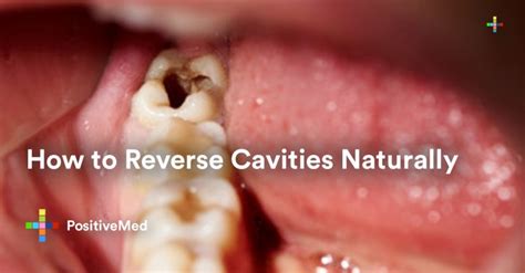 How To Heal Cavities Naturally