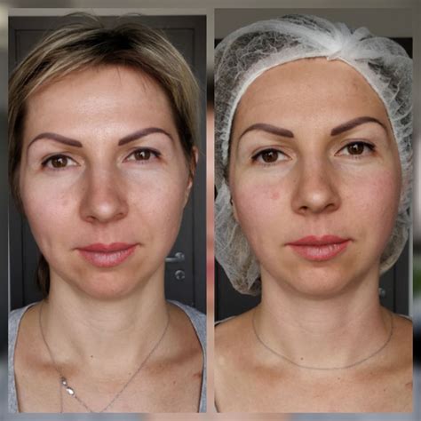 Facial Modeling Massage Results