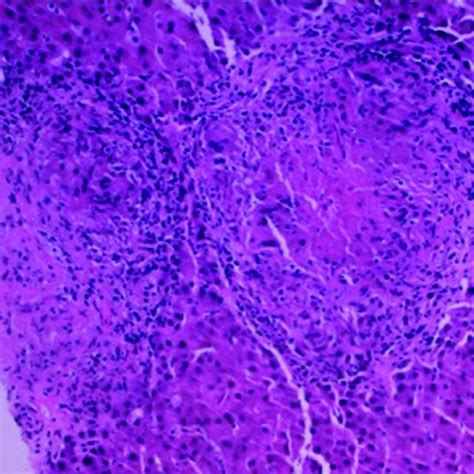 Right Retrocaval Lymph Node Biopsy Showing Granulomatous Formation And