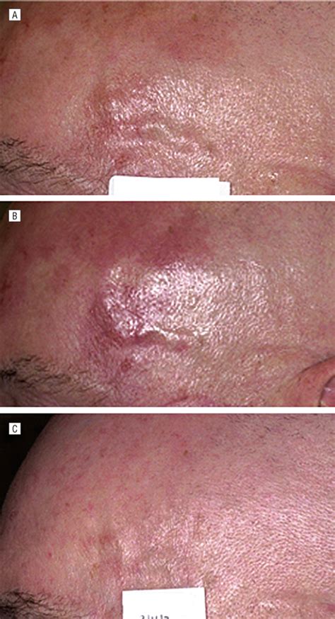 Laser Mediated Photodynamic Therapy Of Actinic Keratoses Dermatology