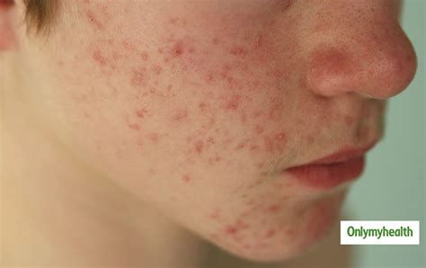 Causes Of Red Spots Acne Or Pimples On Face And Dermatologist Tips To