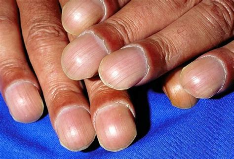 Clubbed Nails Picture Image On