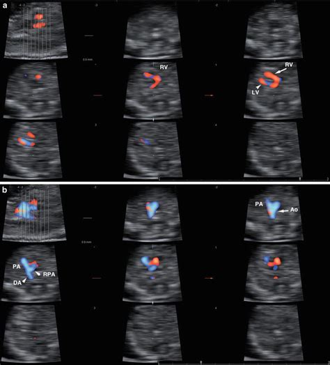 Three Dimensional Ultrasound A Role In Early Pregnancy Radiology Key