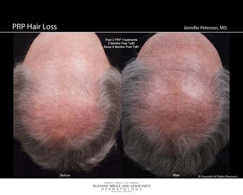 Some in the medical community think that prp injections trigger natural hair growth and maintain it by increasing blood supply to the hair follicle and increasing the thickness of the hair shaft. New Hair Loss Treatment (PRP) - Dermatology in Houston ...