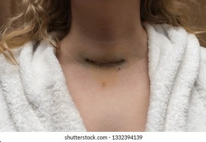 Removal Thyroid Gland Images Stock Photos Vectors Shutterstock