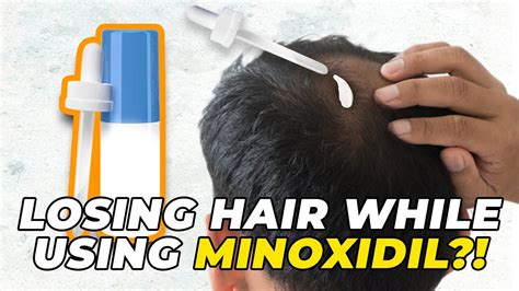 Still Losing Hair While Using Minoxidil This Is Why Youtube