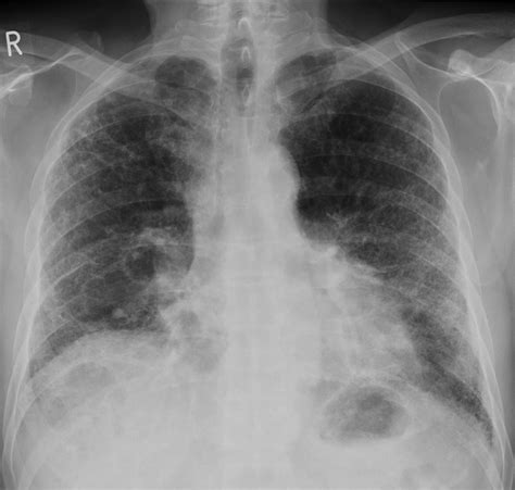 Pulmonary Fibrosis Radiology At St Vincents University Hospital