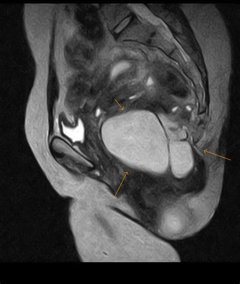 Perirectal Cyst Differentials Sumers Radiology Blog