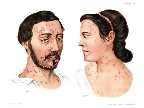 Secondary Syphilis Rash Photograph By Us National Library Of Medicine