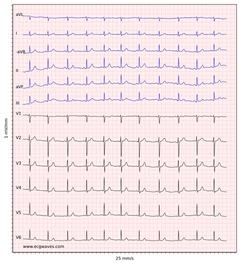 Ecg Interpretation Characteristics Of The Normal Ecg P Wave Qrs