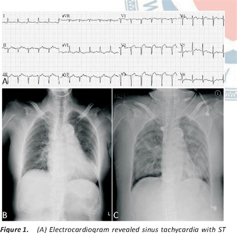 Figure 1 From A Case Of Takotsubo Cardiomyopathy Precipitated By