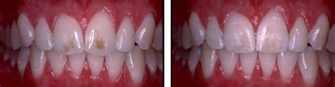 Procedures Bleaching Dr Richard H Berman Dental Art And Science
