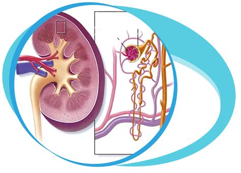 Nephrotic Syndrome Treatment In Iran Medpersia Medical Tourism