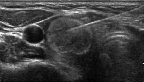 Fine Needle Aspiration Biopsy Ultrasound Of A Right Thyroid Nodule