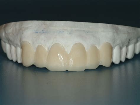 Effective Provisional Restorations V1928 Dental Assisting Ce