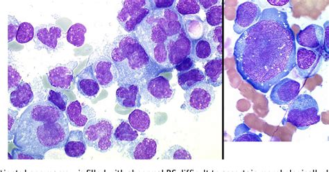 Figure 9 From Plasma Cell Morphology In Multiple Myeloma And Related