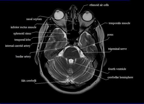 Cross Sectional Anatomy Mri Brain Sagittal Anatomy Free Mri Brain Cross