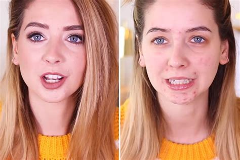 Zoella Bravely Goes Bare Faced On A Bad Skin Day To Show Her Millions