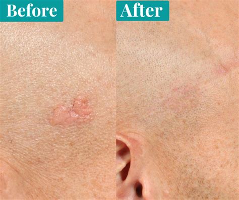 How To Start A Business With Only Mole Removal Iow Epc Services