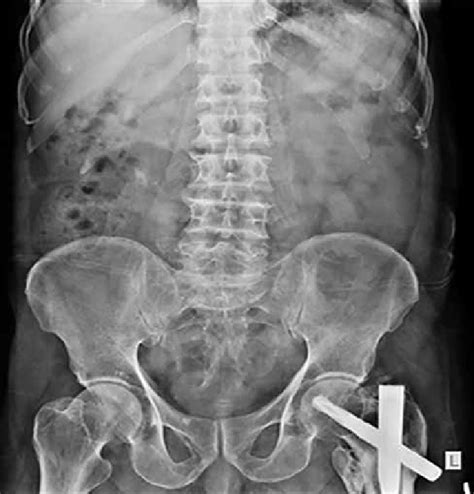 Case contributed by assoc prof craig hacking ◉ ◈. X-ray lumbar spine AP view is unremarkable except for a ...