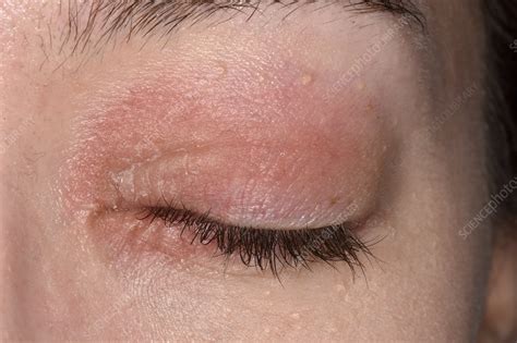 Eczema Affecting The Eyes Stock Image C0472829 Science Photo Library