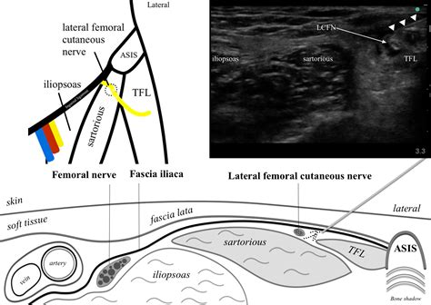 Lateral Femoral Cutaneous Block Highland EM Ultrasound Fueled Pain Management