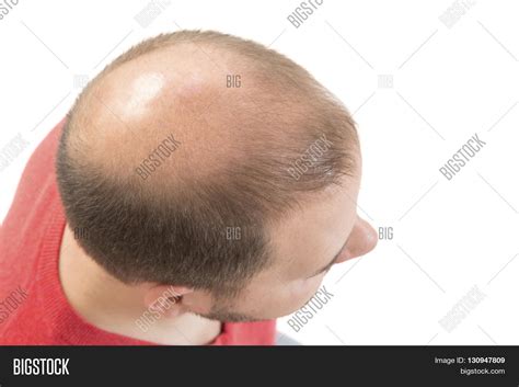 Man Alopecia Baldness Image And Photo Free Trial Bigstock