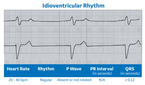 Arrhythmia Recognition Part 2 Clinical View