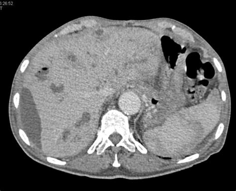 Multiple Liver Abscess With Pneumobilia Liver Case Studies Ctisus