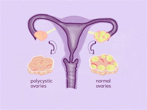 How Can I Detect Pcos Cyclotest